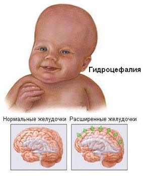 Гидроцефалия (водянка мозга)