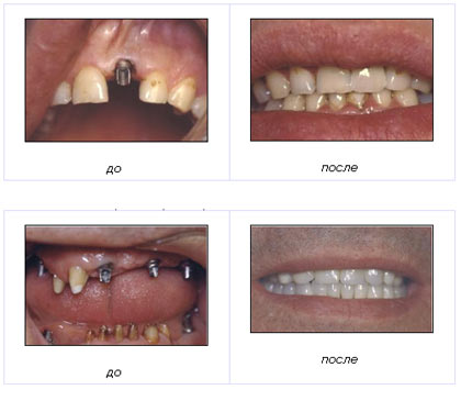 Дефекты зубных рядов
